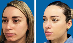 rinoplastia