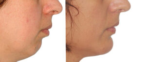 Mentoplastia